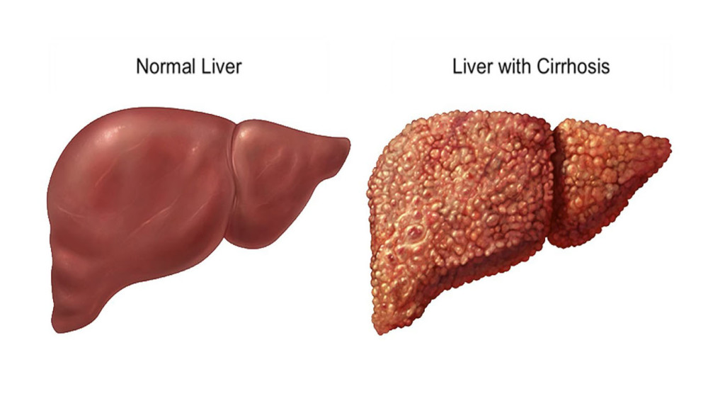 fegato-normale-e-fegato-cirrotico